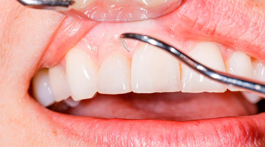 Что такое киста зуба?